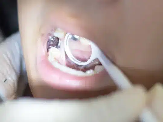 Dental Sealant Application