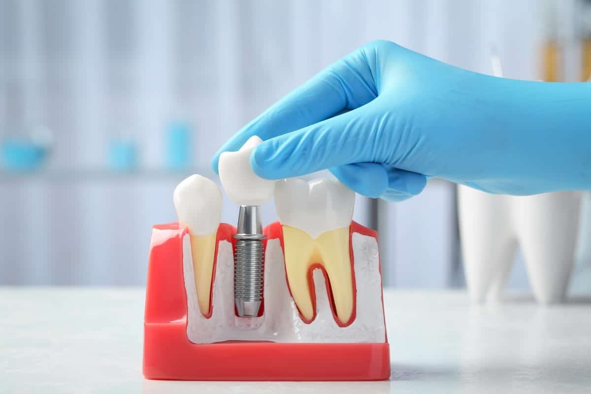 Dental Crowns in Sacramento